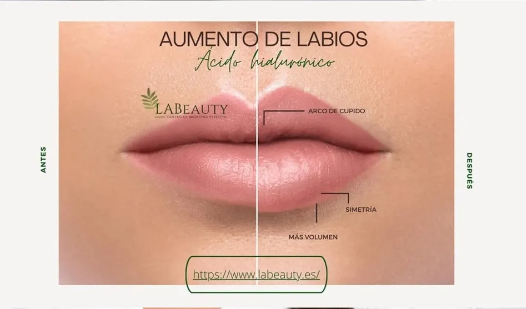 Aumento de labios