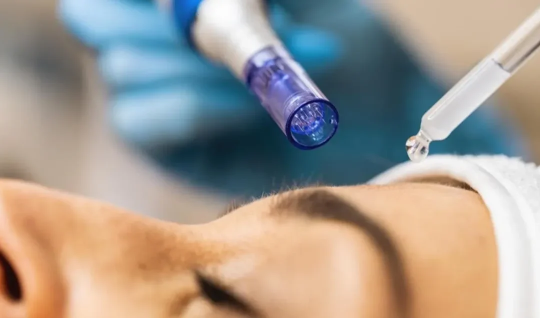 Microneedling Phibright